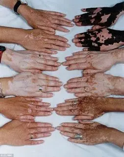 Body shaming 1
